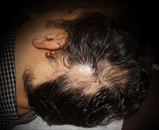 درمان طاسی منطقه ای سر (آره اتا)با تزریق PRP